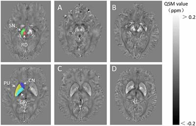 Elevated Heme Oxygenase-1 Correlates With Increased Brain Iron Deposition Measured by Quantitative Susceptibility Mapping and Decreased Hemoglobin in Patients With Parkinson’s Disease